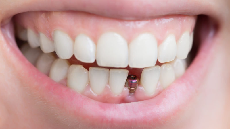 Do Dental Implants Functions Like Your Natural Teeth?